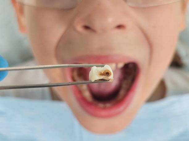 Best Emergency Tooth Extraction  in Long Beach, MD